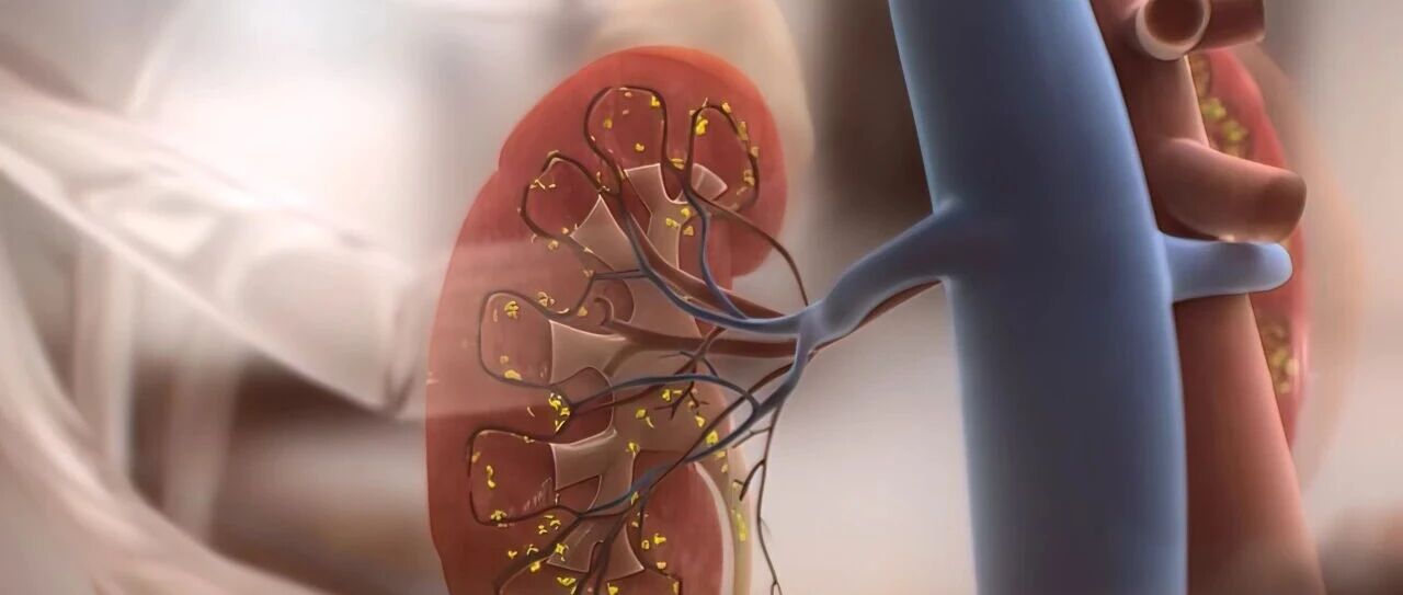 指南共识｜肥胖与CKD的关系：KDIGO争议会议的结论