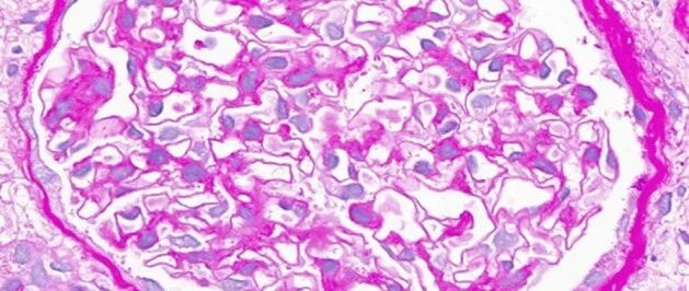 揭示不寻常的面纱：肾活检发现系统性红斑狼疮的罕见病理